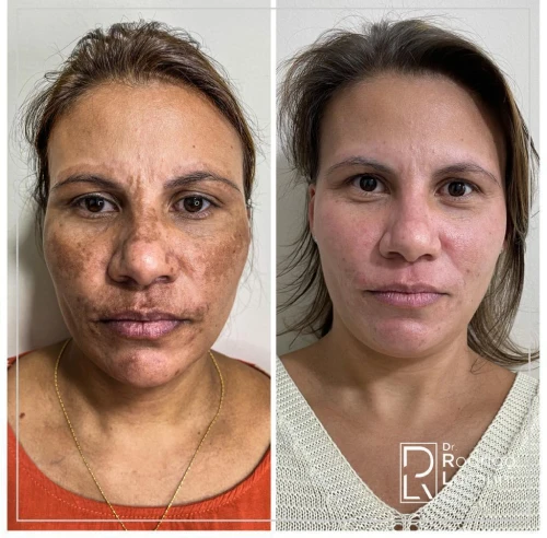 antes_depois_02